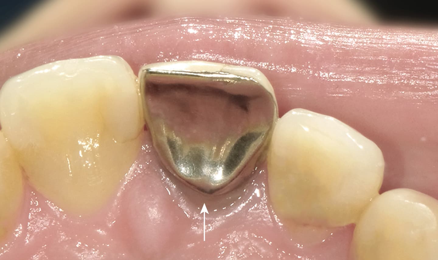 症例02_ビフォー（前歯-裏）