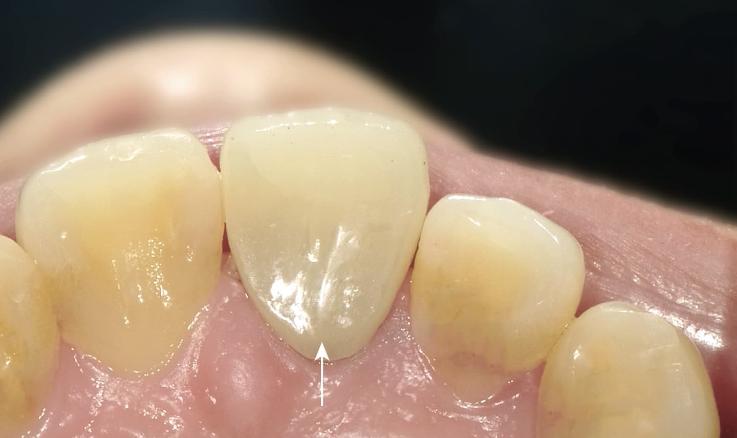 症例02_アフター（前歯-裏）