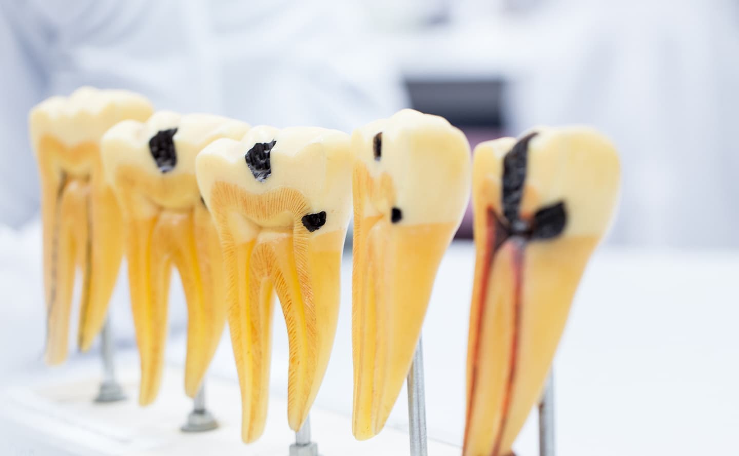 虫歯のイメージ画像