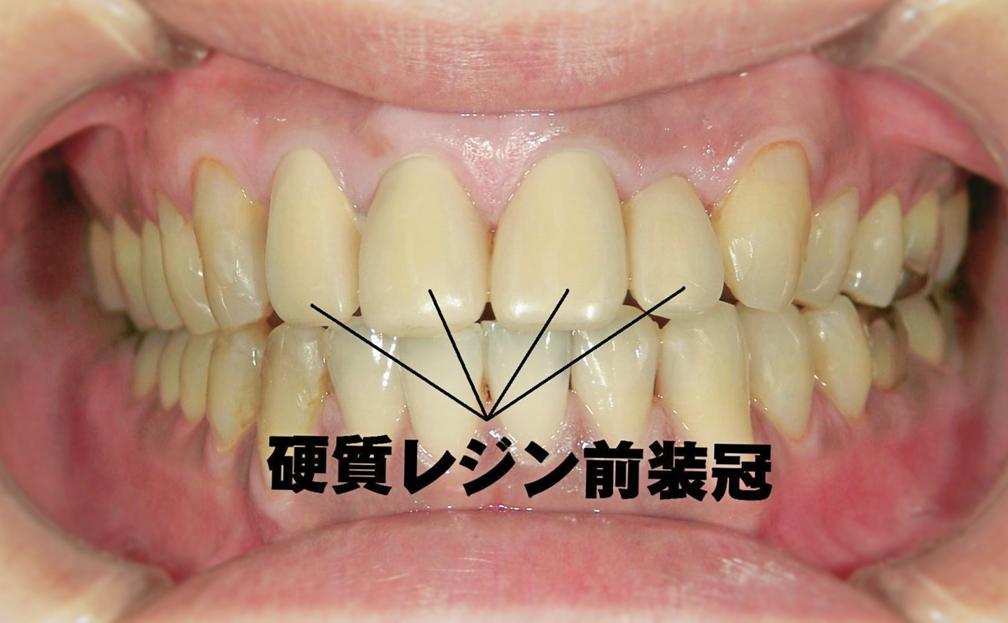 硬質レジン前装冠