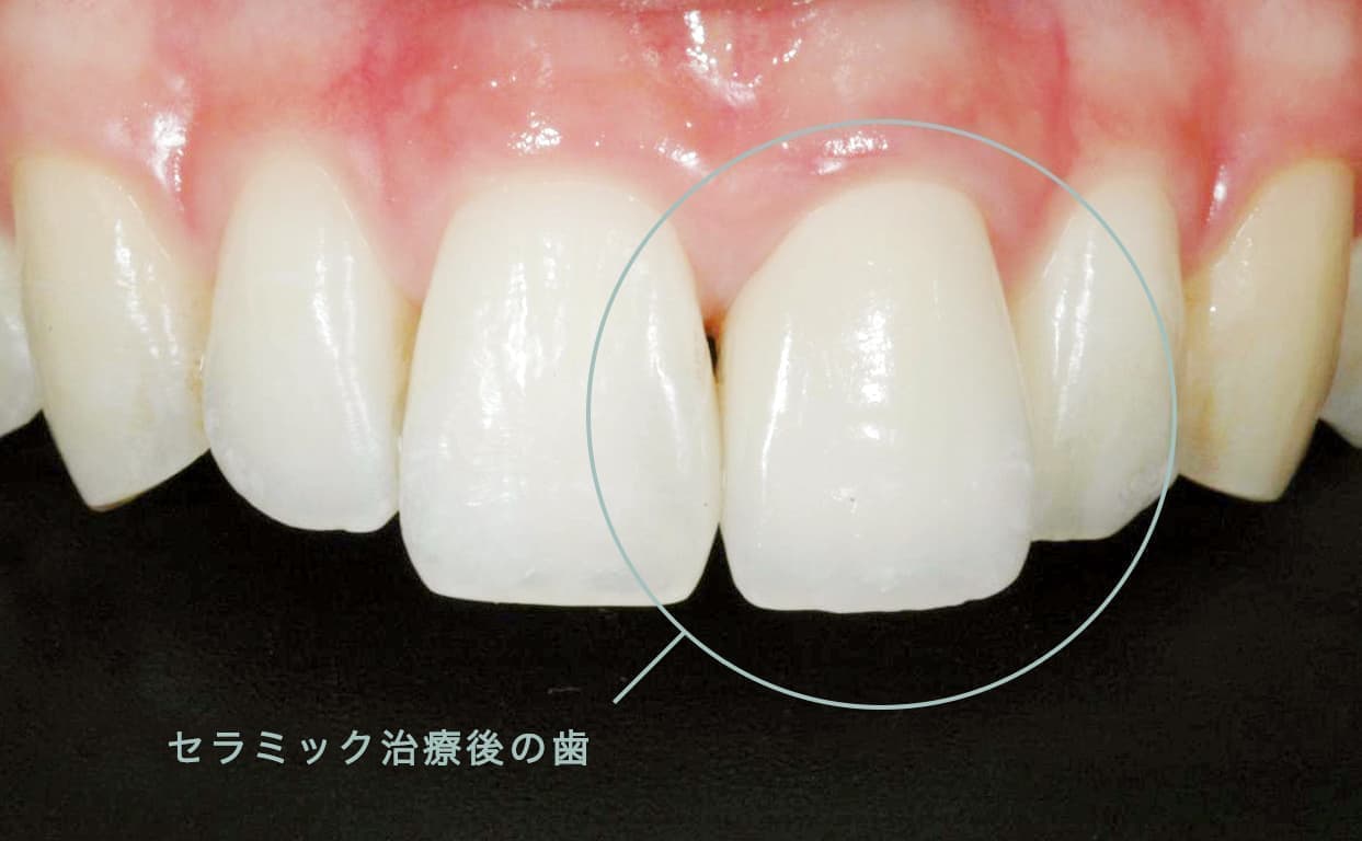 セラミック治療の歯