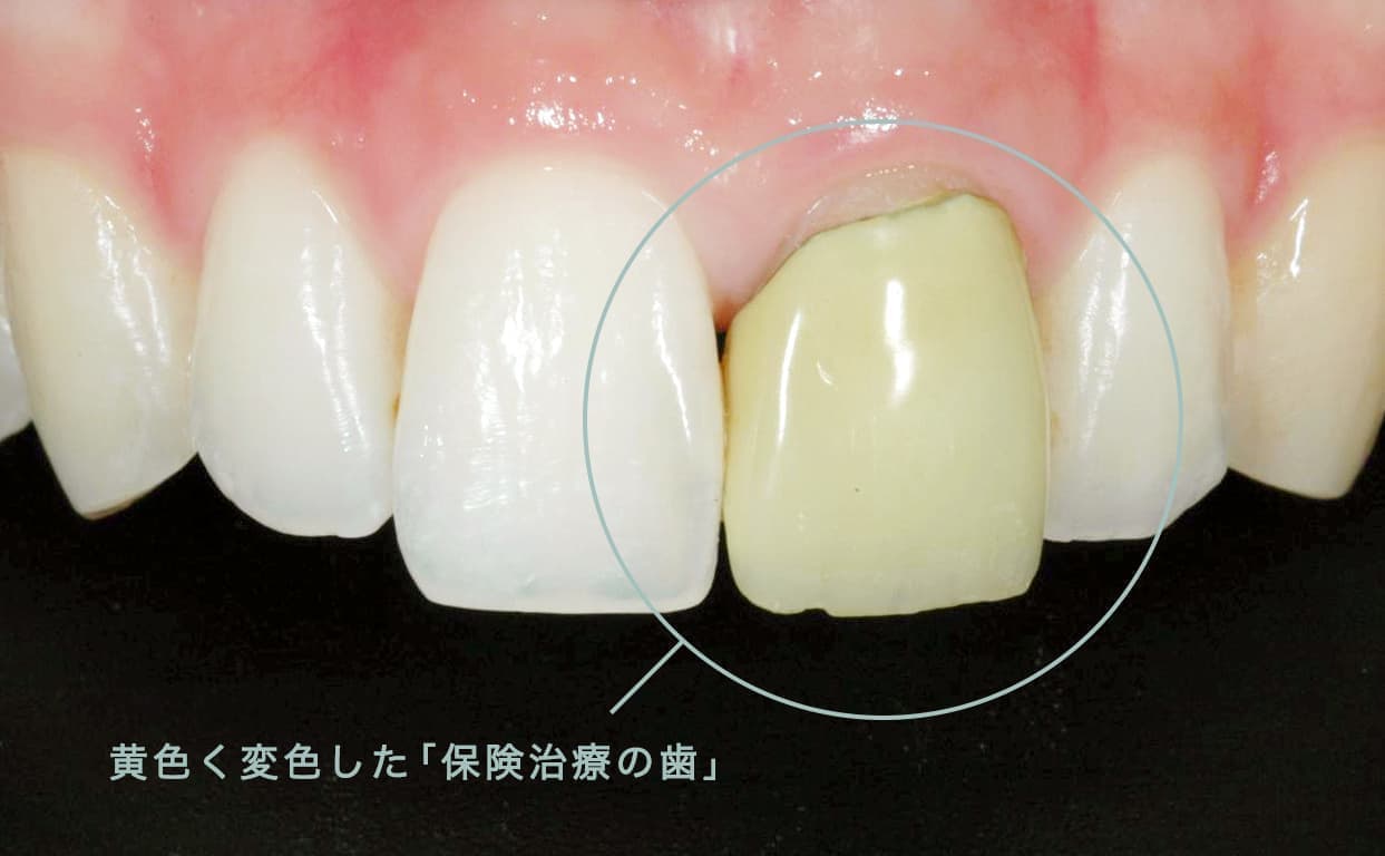 保険治療の歯