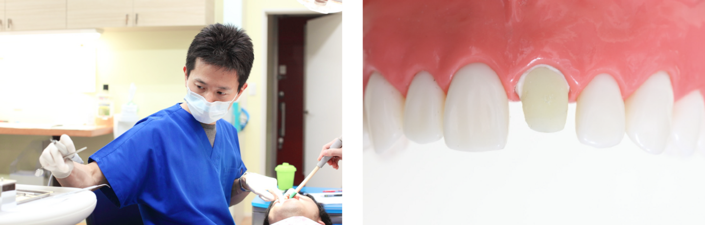 形成の治療イメージ、模型