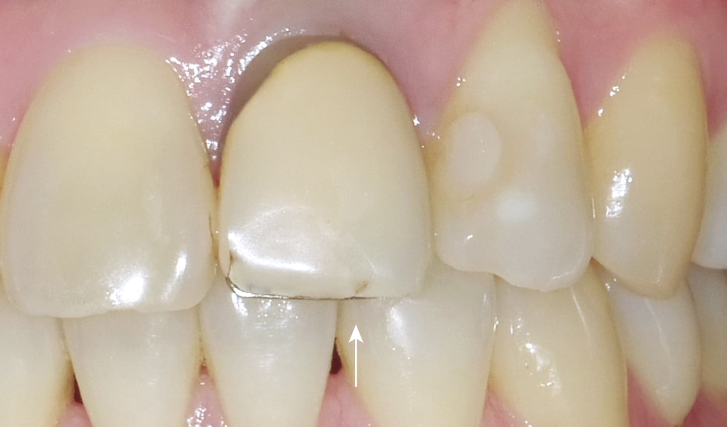 症例02_ビフォー（前歯-表）