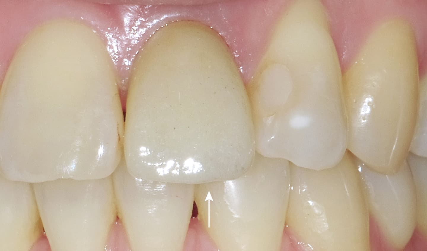 症例02_アフター（前歯-表）